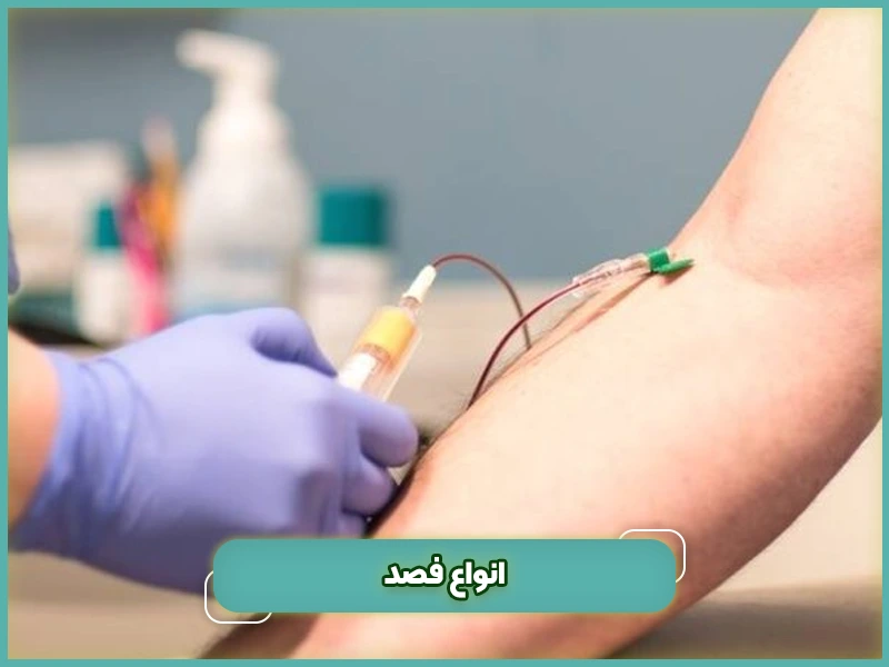 انواع فصد
