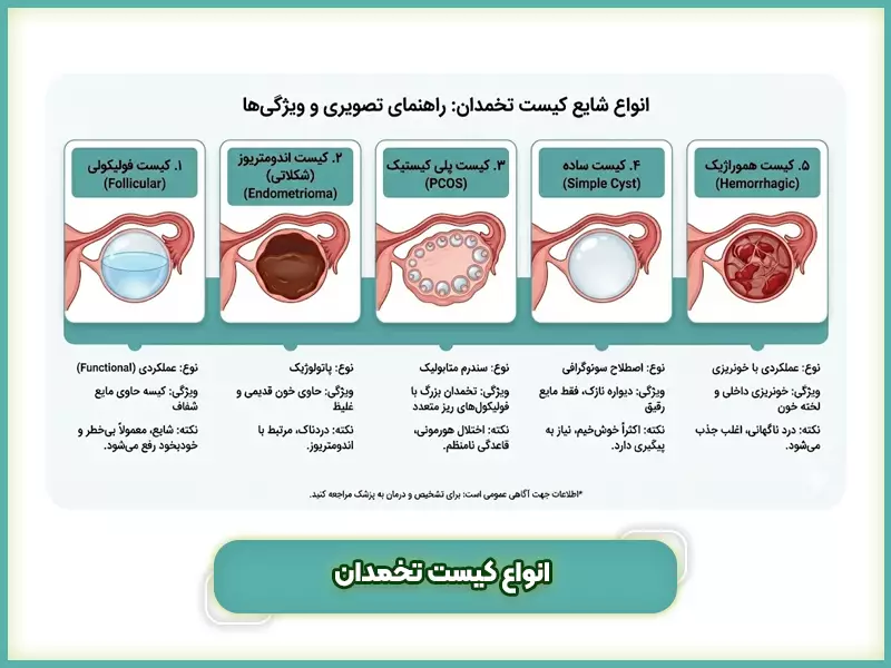 انواع کیست تخمدان