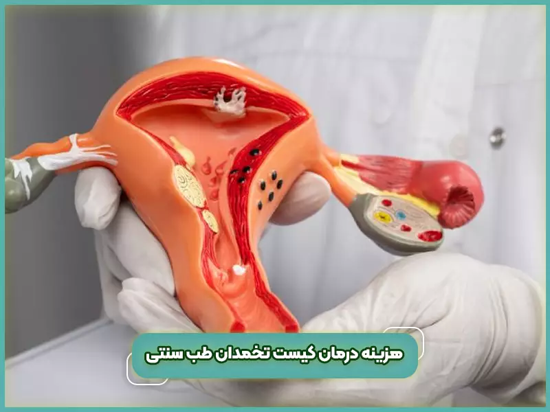 هزینه درمان کیست تخمدان طب سنتی